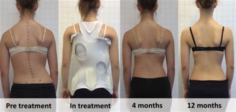 Scoliosis Treatment Brace Pictures Clearance Prices | dev-techtatva ...