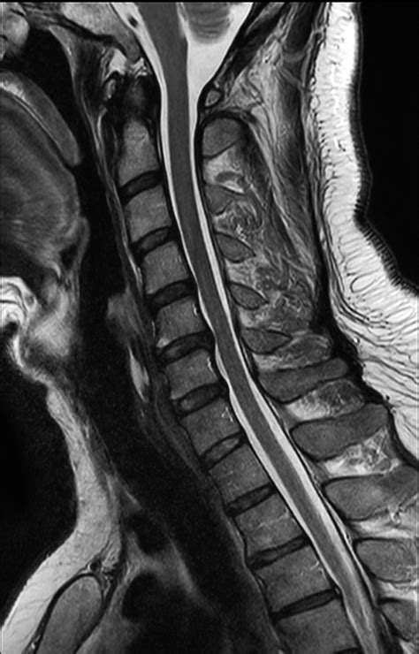 Comprehensive Cervical Spine Imaging At T Philips Mr Body Map