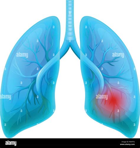 Lungenerkrankung Stock Vektorgrafiken Kaufen Alamy