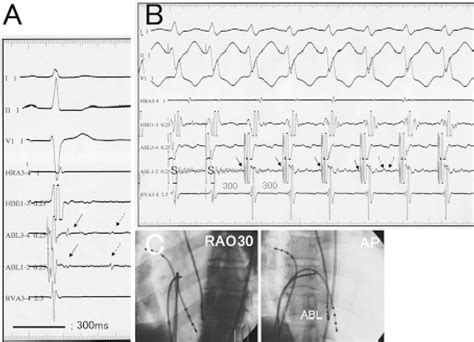 Intracardiac Electrograms At The Site Of Successful Ablation During