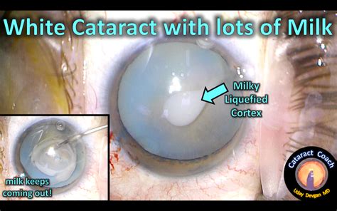 Intumescent White Cataract With Lots Of Milk Cataract Coach™