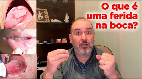 O Que Uma Ferida Na Boca Como Proceder Youtube