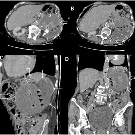 Left Renal Artery Aneurysm On Abdominal Ultrasound With The Transducer