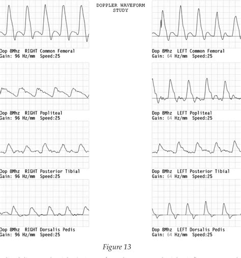 Arterial Waveforms Ultrasound