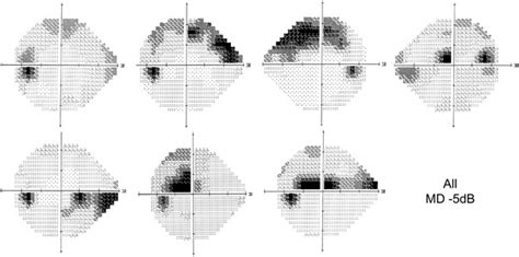 Visual Field Test Usesproceduretypes And Cost