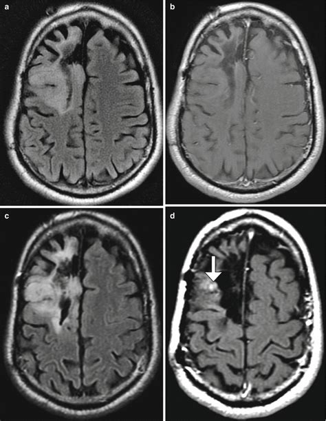 Imaging The Intraoperative And Postoperative Brain Radiology Key