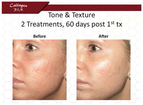 Microneedling Before And After Photos Dermatology Boca Raton