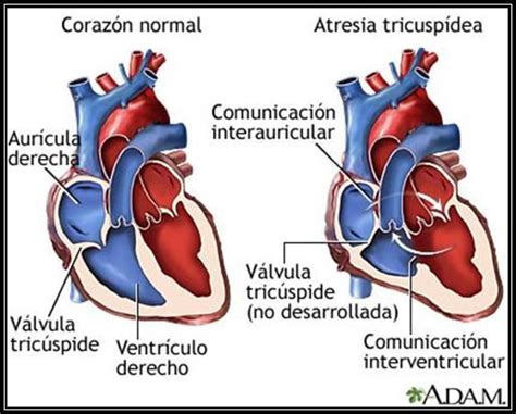 Todo Sobre Enfermería Y Medicina Cardiopatias Congénitas