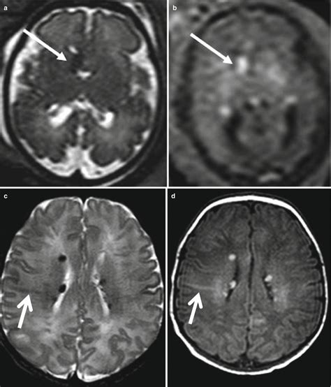 Malformations Of Cortical Development Radiology Key