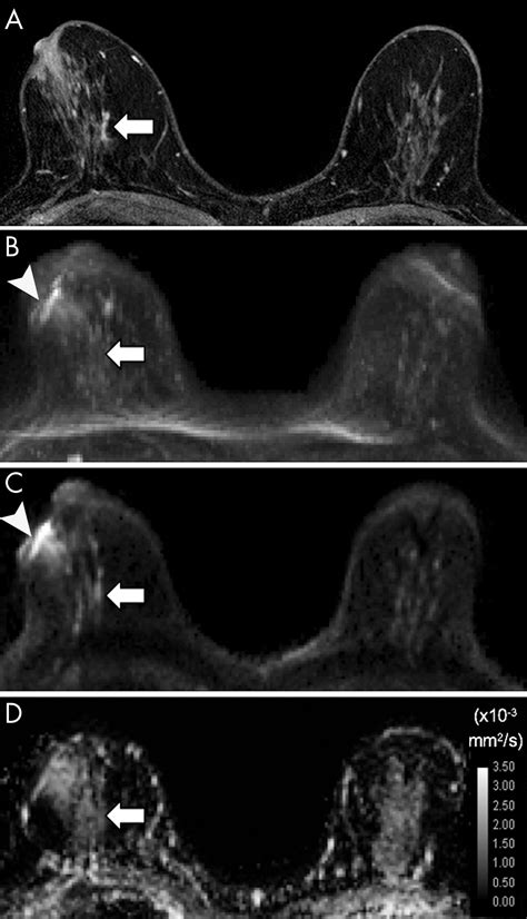 Diffusion Weighted Mri For Unenhanced Breast Cancer Screening Radiology