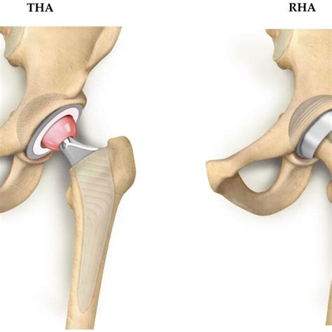 Illustration of total hip arthroplasty (THA) and resurfacing hip ...