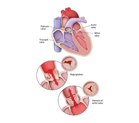 Heart Valve Diseases Temple Health