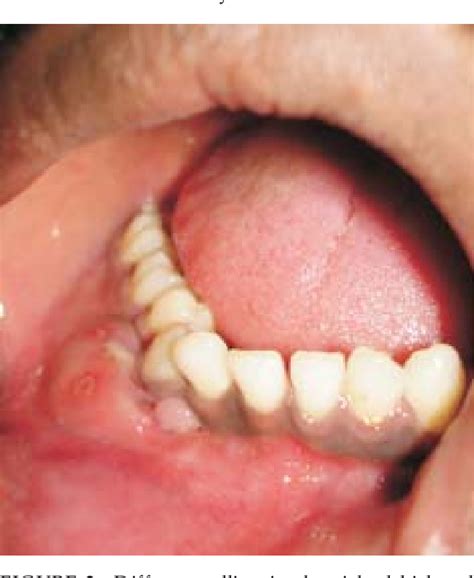 Figure From Non Syndromic Multiple Odontogenic Keratocysts Report Of