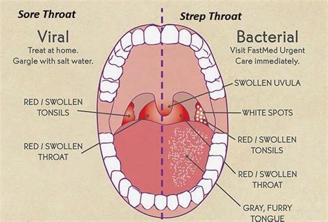 Sore Throat: Causes, Symptoms, & Remedies » How To Relief