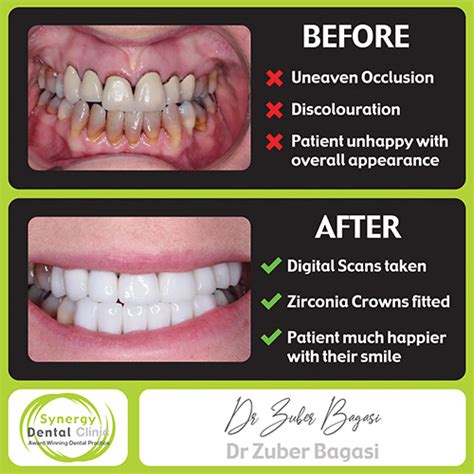 Zirconia Crowns • Synergy Dental Clinics