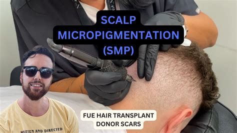 Scalp Micropigmentation Smp For Donor Area Scars After Fue Hair