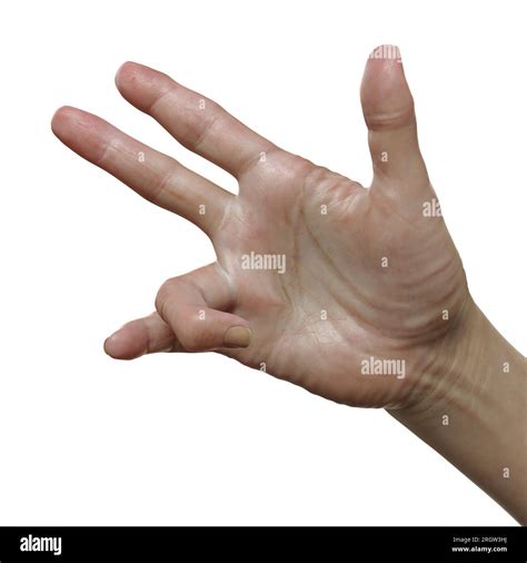 Dupuytrens Contracture Illustration Stock Photo Alamy