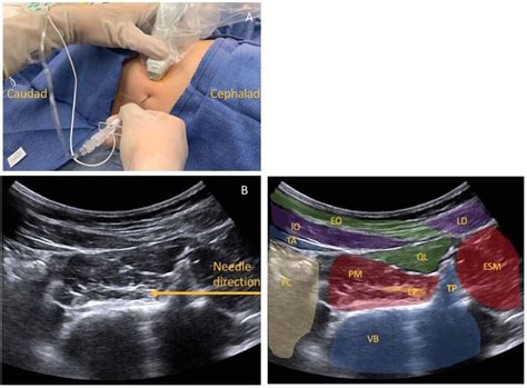 Lumbar Plexus Block