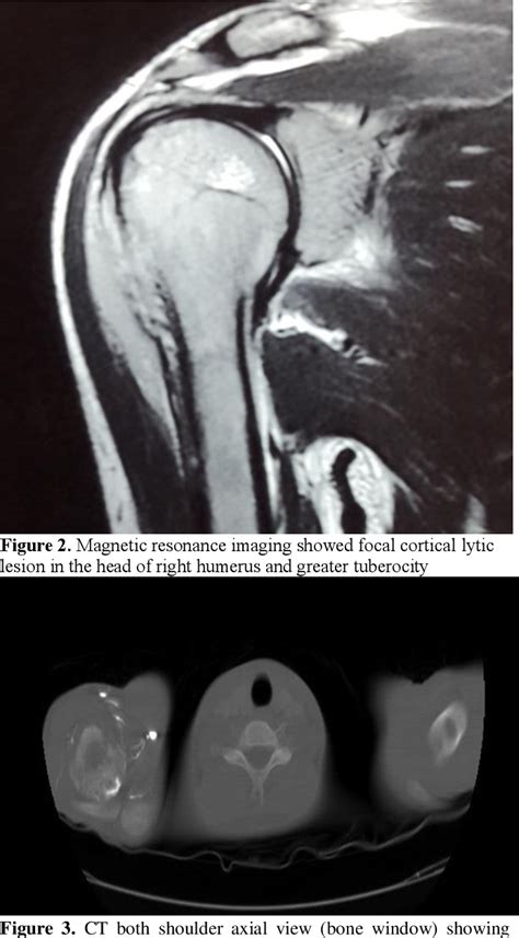 Figure 1 From Osteolytic Bone Lesions A Rare Presentation Of Aml M6