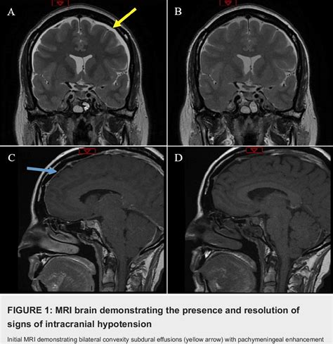 PDF Postoperative Diabetes Insipidus Mimicking Radiological Findings