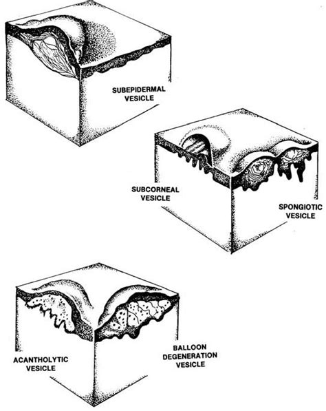 Macule Vs Papule