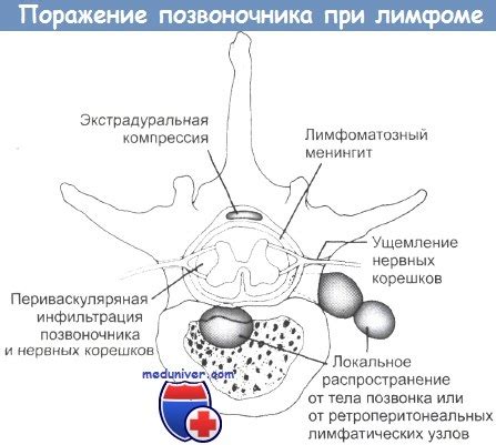 Поражение центральной нервной системы при лимфоме - клиника, лечение