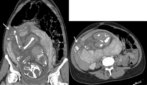 Spontaneous Uterine Rupture Of An Unscarred Uterus Revealed By A