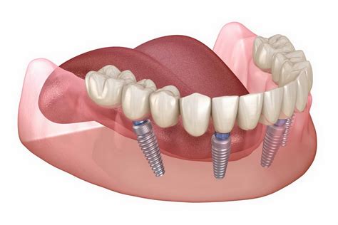 Prodental Novi Beograd De Urni Stomatolog Snimanje Zuba D