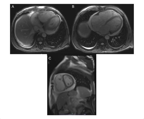 Cardiac Magnetic Resonance Imaging Cmr Showing Pericardial Effusion