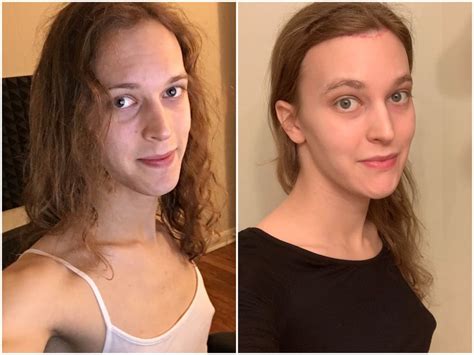 3 Months Hrt 29 Months Hrt 2 Months Post Ffs Transtimelines