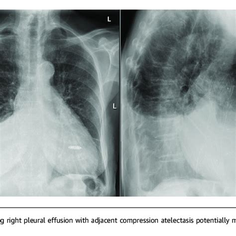 Radiography Of The Chest Anteroposterior And Lateral Views At Admission Download Scientific