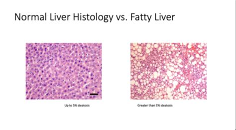 Fatty Liver Dx / Metabolic Liver Dx Flashcards | Quizlet