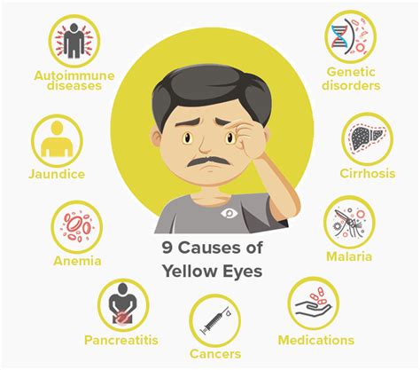 Yellow Eyes: Causes and Treatment