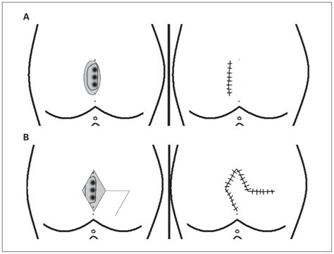 Limberg Flap Versus Karydakis Flap For Treating Pilonidal Sinus Disease