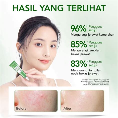 Jual You Acne Spot Obat Totol Jerawat Shopee Indonesia