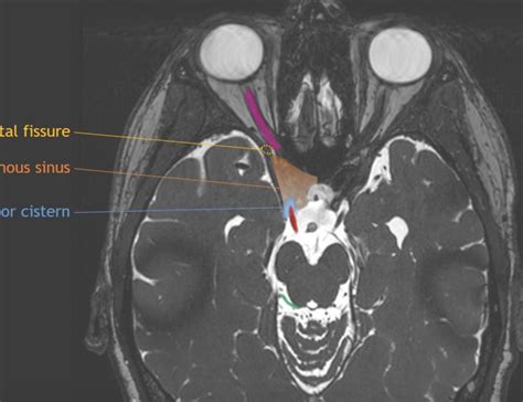CaseStacks.com - Cranial Nerve Anatomy on MRI
