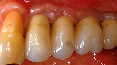 Soft Tissue Management And Grafting Around Dental Implants Esthetic And Mucog Gide Dental