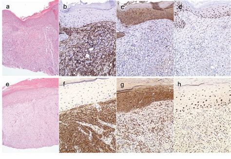 Table 1 From Diagnostic Utility Of P63 And Cd10 In Distinguishing