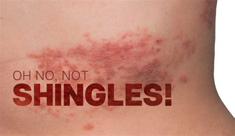 Shingles The Uncomfortable Truth Nj Healthsource