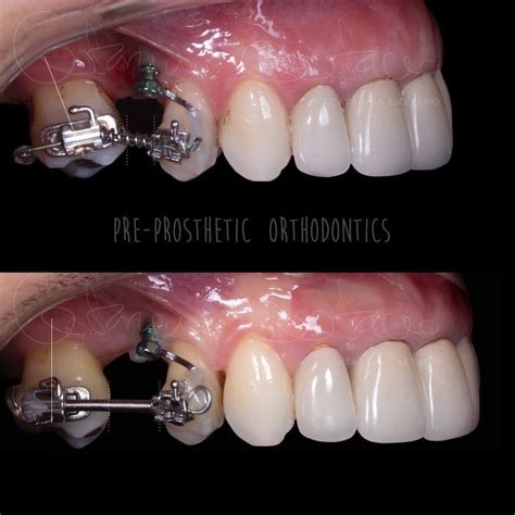 Pre Prosthetic Segmented Orthodontics To Upright Molar And Rearrange