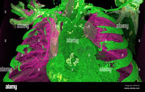 Bovine aortic arch variant, CT scan Stock Photo - Alamy