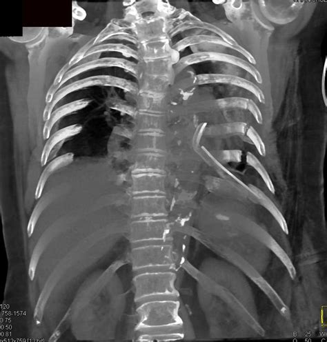 Rib Fracture CT Scan