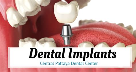 Implant Pattaya Dental Clinic Dental Clinic Pattaya Dentist Pattaya