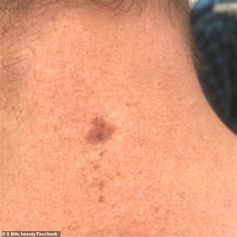 Father notices sun spot on his neck before doctors are forced to remove ...