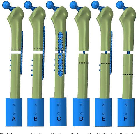 Figure From Periprosthetic Femoral Fracture A Biomechanical