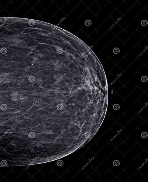 X Ray Digital Mammogram Or Mammography Of Both Side Breast Standard