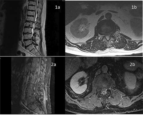 Preoperative Mri 1a Sagittal T2 Weighted Image 1b Axial T2 Weighted