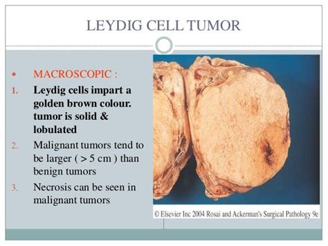 Testicular Tumors