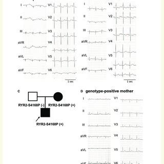 Clinical Features Of The Proband With Ryr S P A A Lead Ecg Of