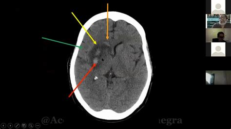 Accidente Cerebrovascular ACV Parte4 Diagnostico Del ACV Signos